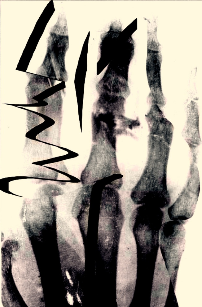 Munch, broken hand